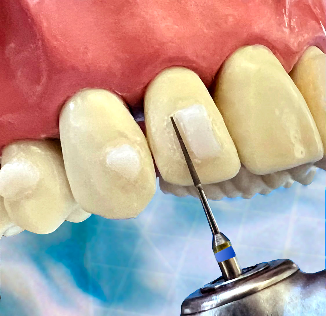 Composite Attachment Burs (CAB)