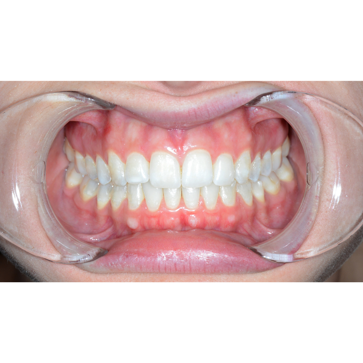 Plastic Double-Ended Cheek Retractors in mouth