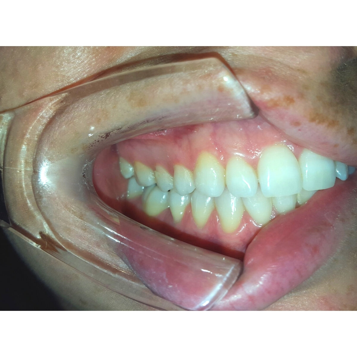 Buccal Cheek Retractor in mouth