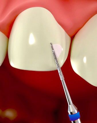 Composite Attachment Bur (CAB) - FINE 6.0 (2, 5, 10 PC PKS)
