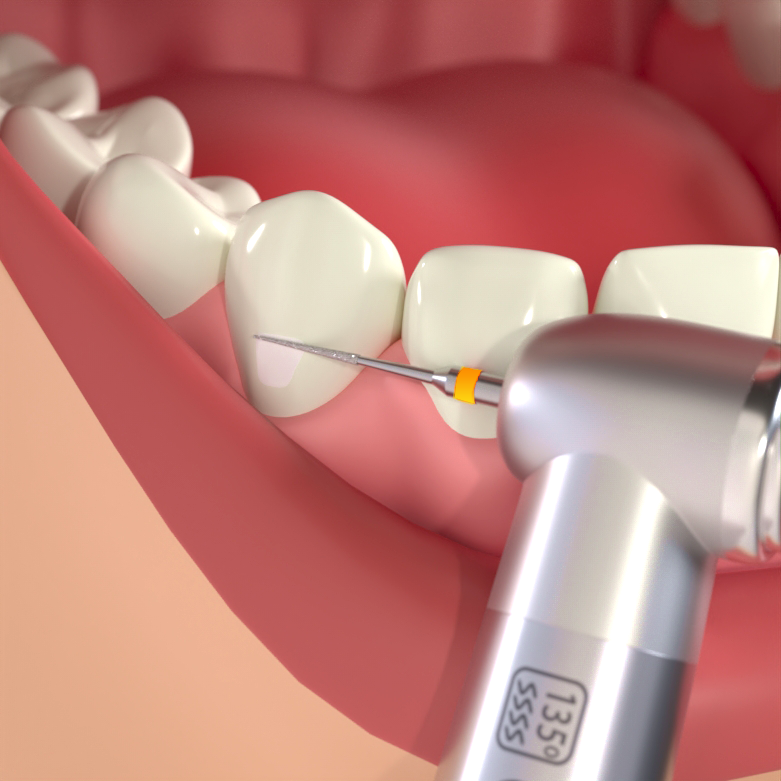 Composite Attachment Bur (CAB) - EXTRA SUPER FINE 6.0 (2, 5, 10 PC PKS)