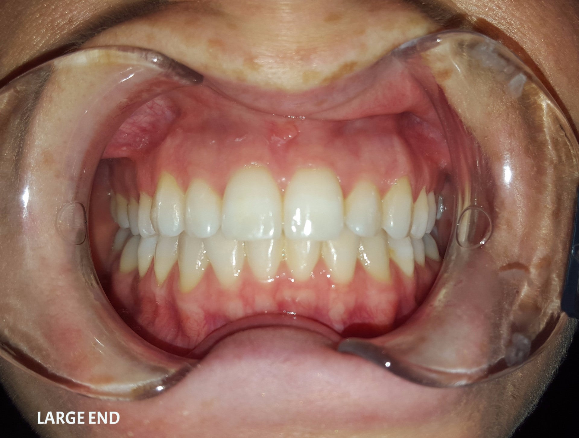 Plastic Double-Ended Cheek Retractor - Small