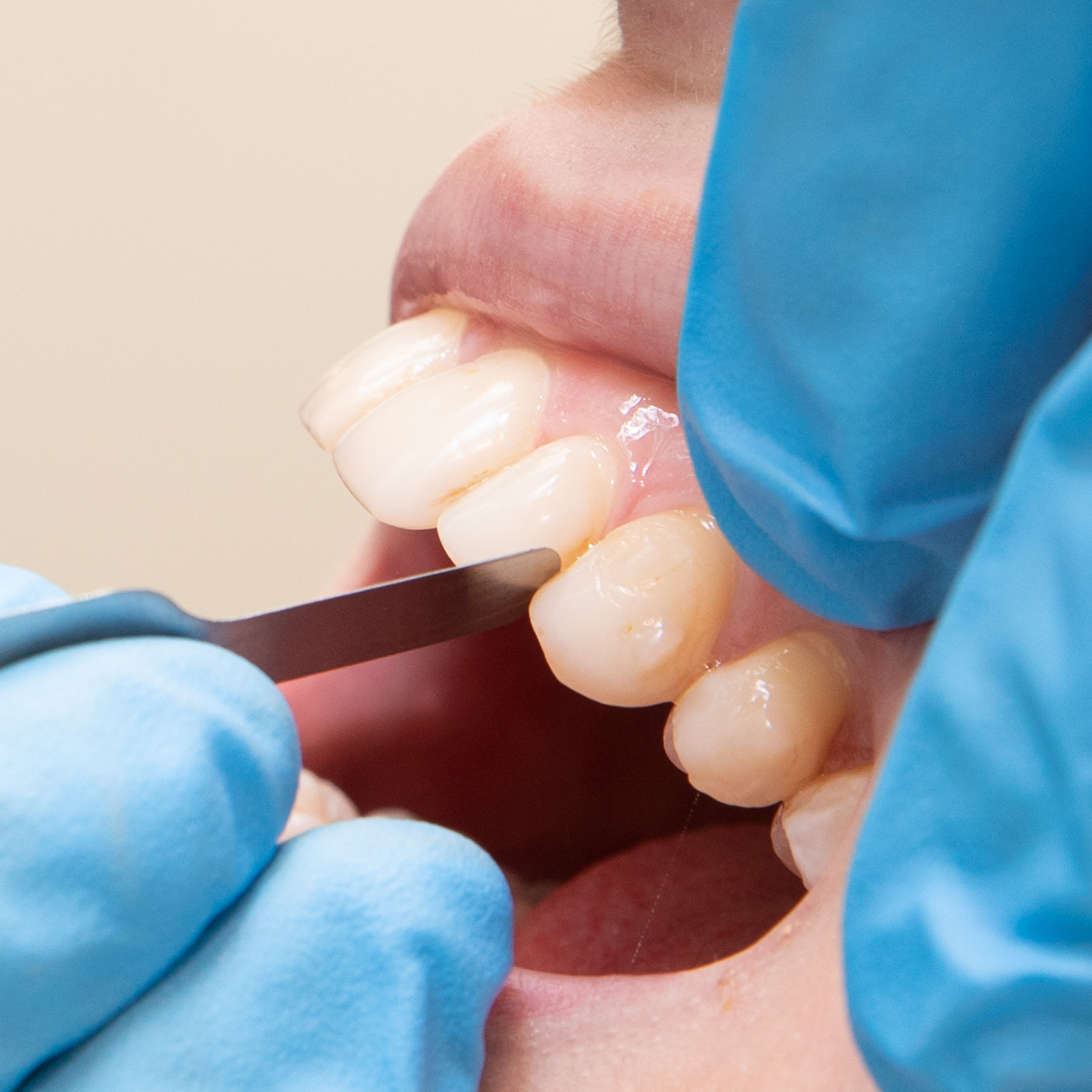 IPR Gauges in mouth