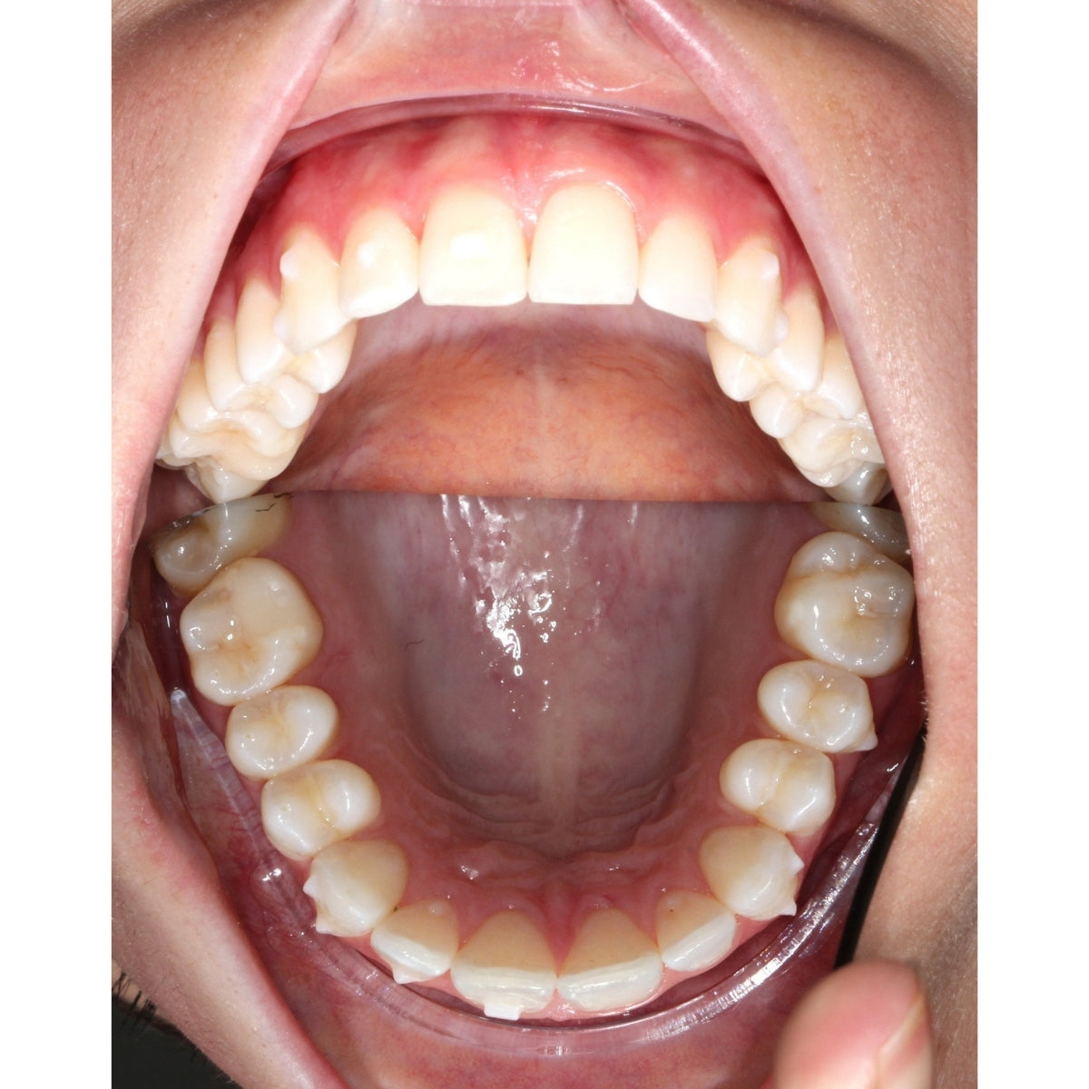 Plastic Single-Ended Lip Retractor in mouth