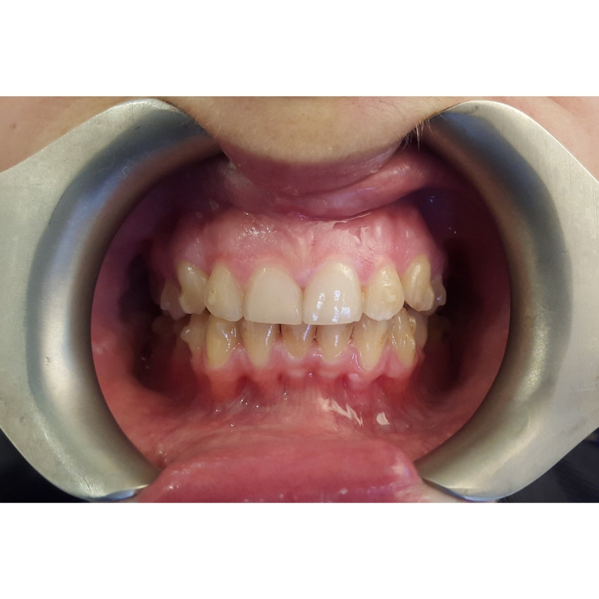 Metal Double-Ended Cheek Retractors in mouth