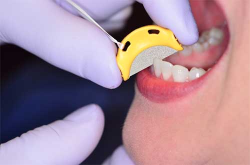 QwikStrip in mouth