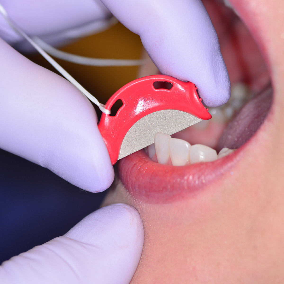 Red QwikStrip in mouth