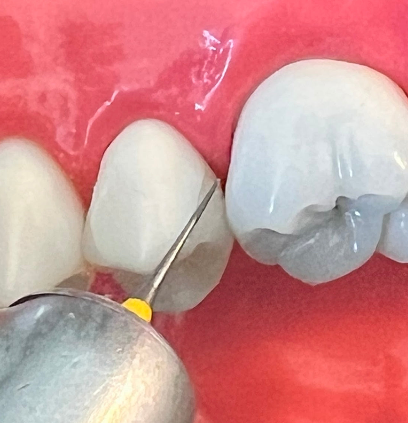 i-PR Super Fine Bur 3.5mm (2, 5, 10 PC PKS)