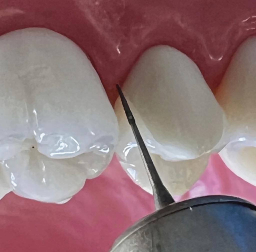 Margins Bur - FINE 6.0 (2, 5, 10 PC PKS)