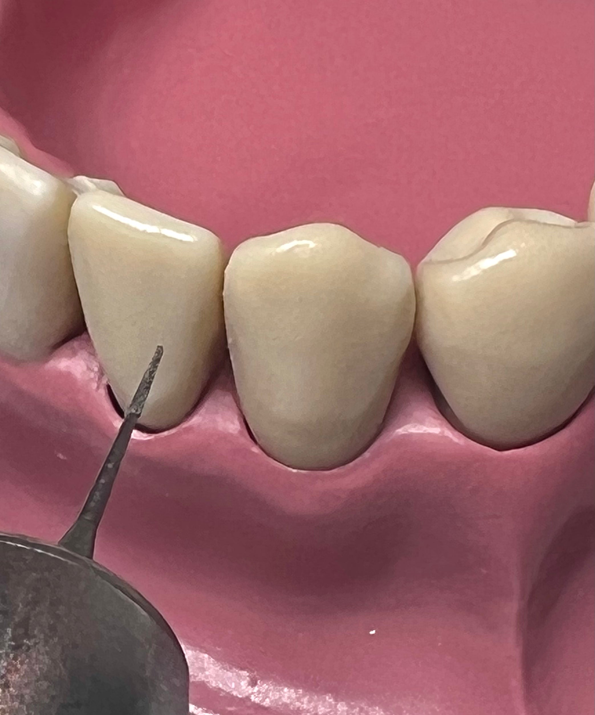 i-PR Extra Super Fine Bur 6.0mm (2, 5, 10 PC PKS)