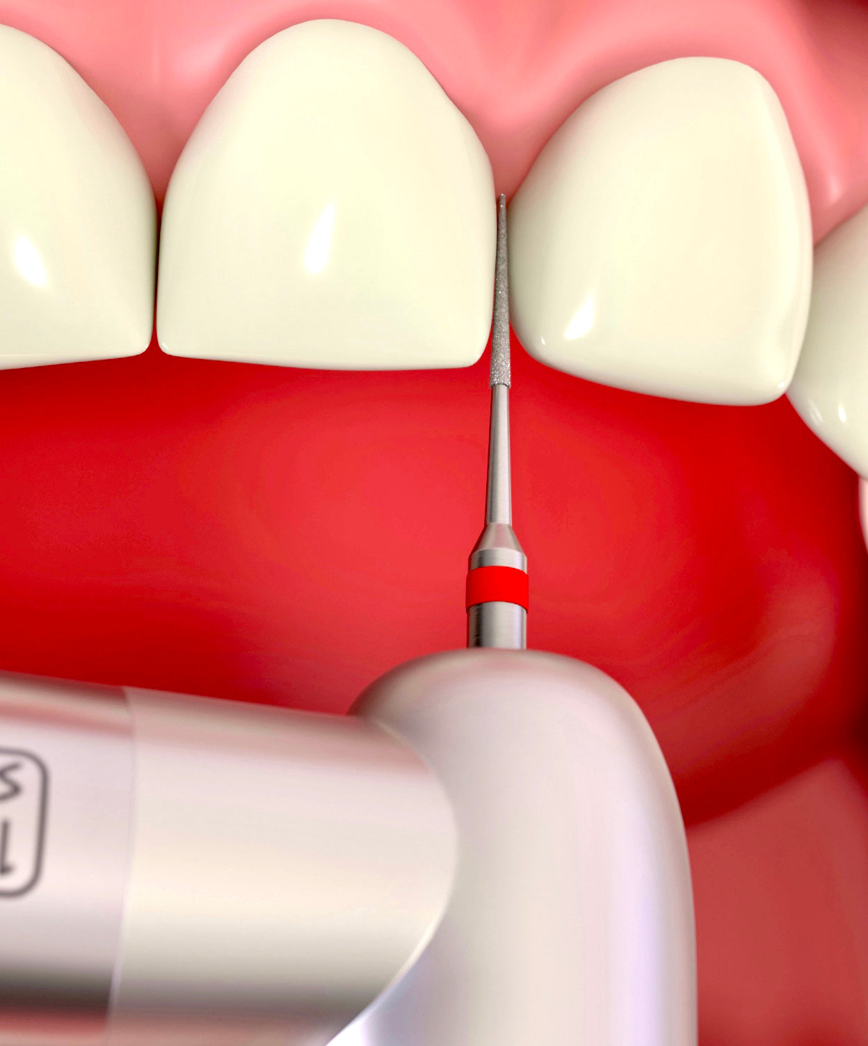 i-PR Interproximal Reductions Burs – EOCA