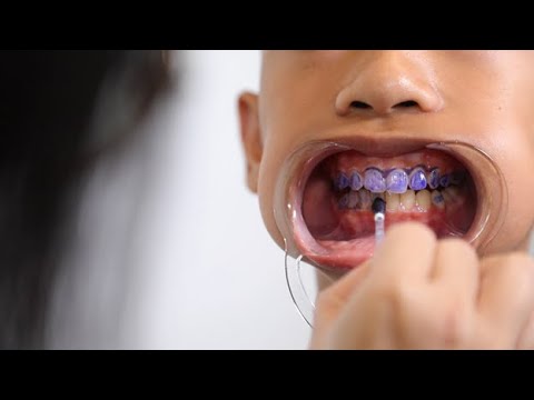 Divulge Bacterial Disclosing Swabs