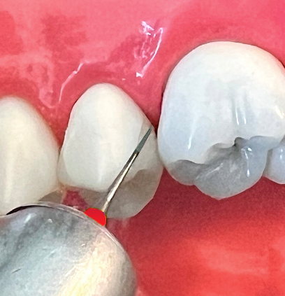 Composite Attachment Bur (CAB) - SUPER FINE 3.5 (2, 5, 10 PC PKS)