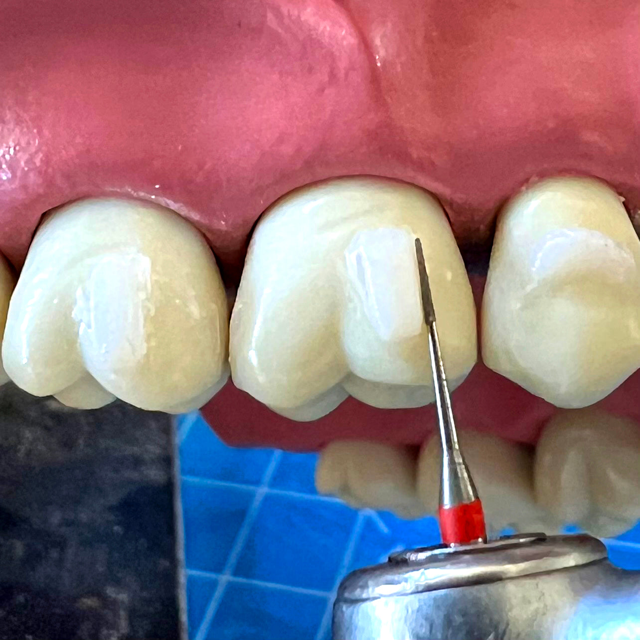 Composite Attachment Bur (CAB) - SUPER FINE 3.5 (2, 5, 10 PC PKS)