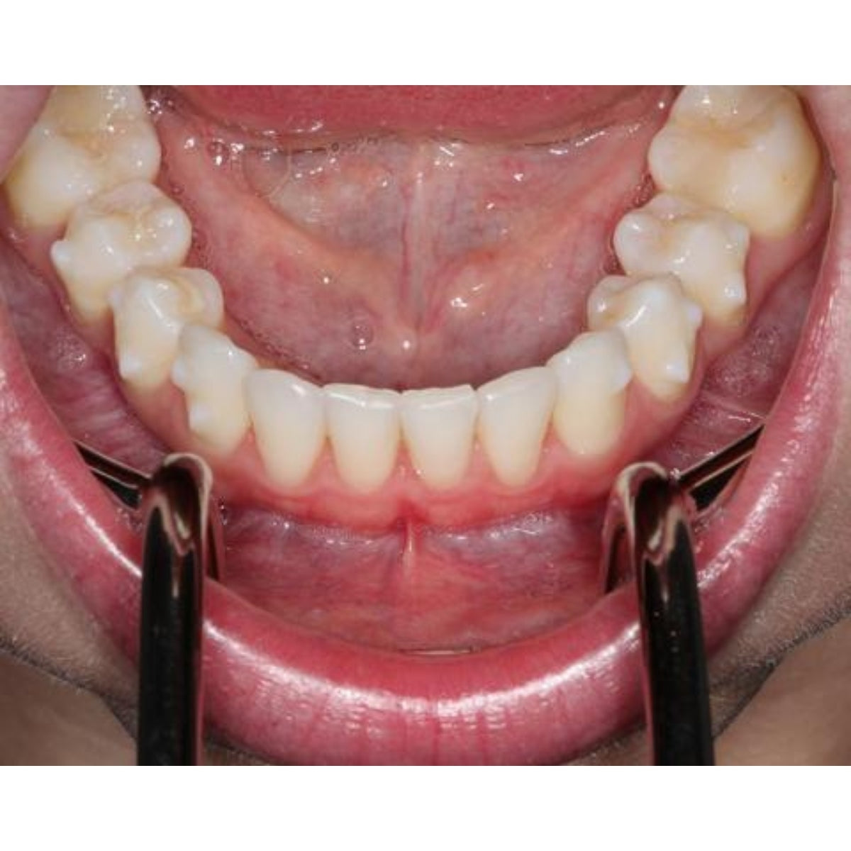 Metal Single-Ended Lip Retractor in mouth