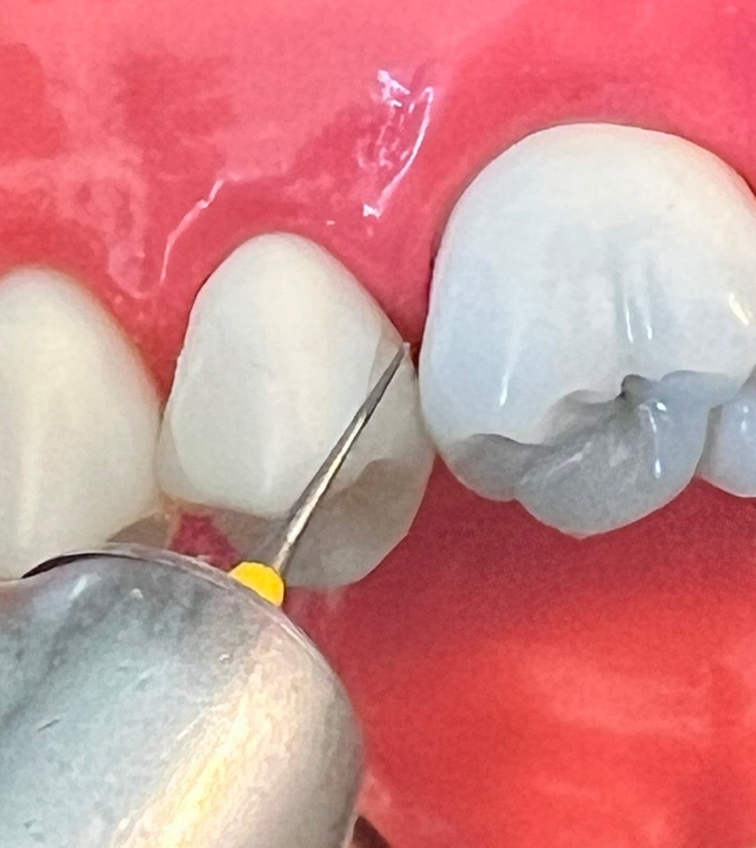 i-PR Extra Super Fine Bur 3.5mm (2, 5, 10 PC PKS)
